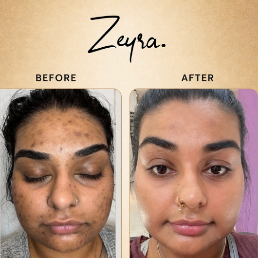 Zeyra Skin Brightening Cream for Dark Spots & Glowing Skin